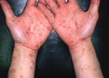 Manchas na pele são sintomas da doença. Foto: Yomiuri Shinbum.
